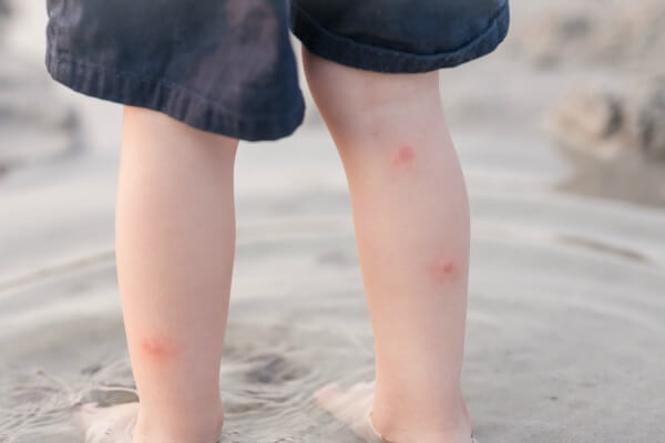 Stop mosquito bite itchies in their tracks!