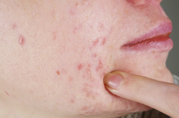 Here are three foods that cause acne, and some natural remedies, too!